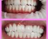Tanden bleken Antwerpen X-Treme Smile